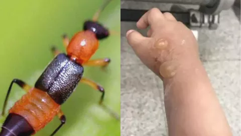 河南隐翅虫事件